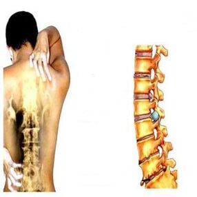 Osteochondrosis phase