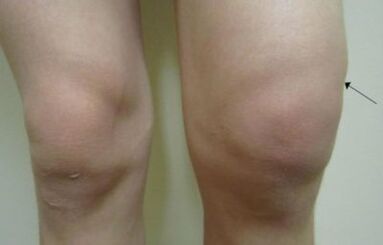 Clinical manifestations of arthrosis of the knee joint