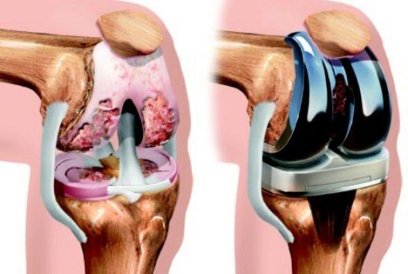 Before and after the endoprothetic of the knee joint with arthrosis