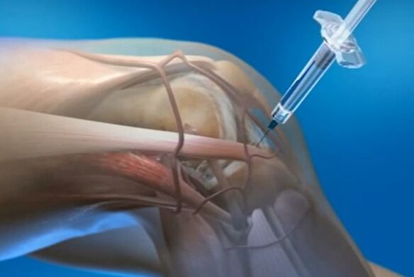 intra -articular injections for arthrosis of the knee joint
