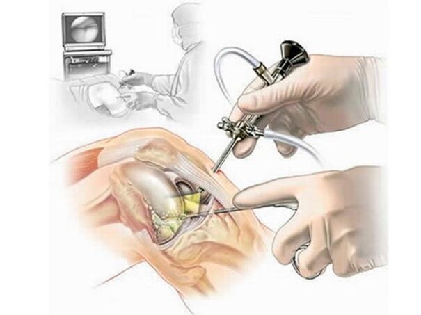 Knee arthroscopy